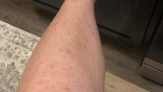 Lower Leg Before Laser Hair Removal