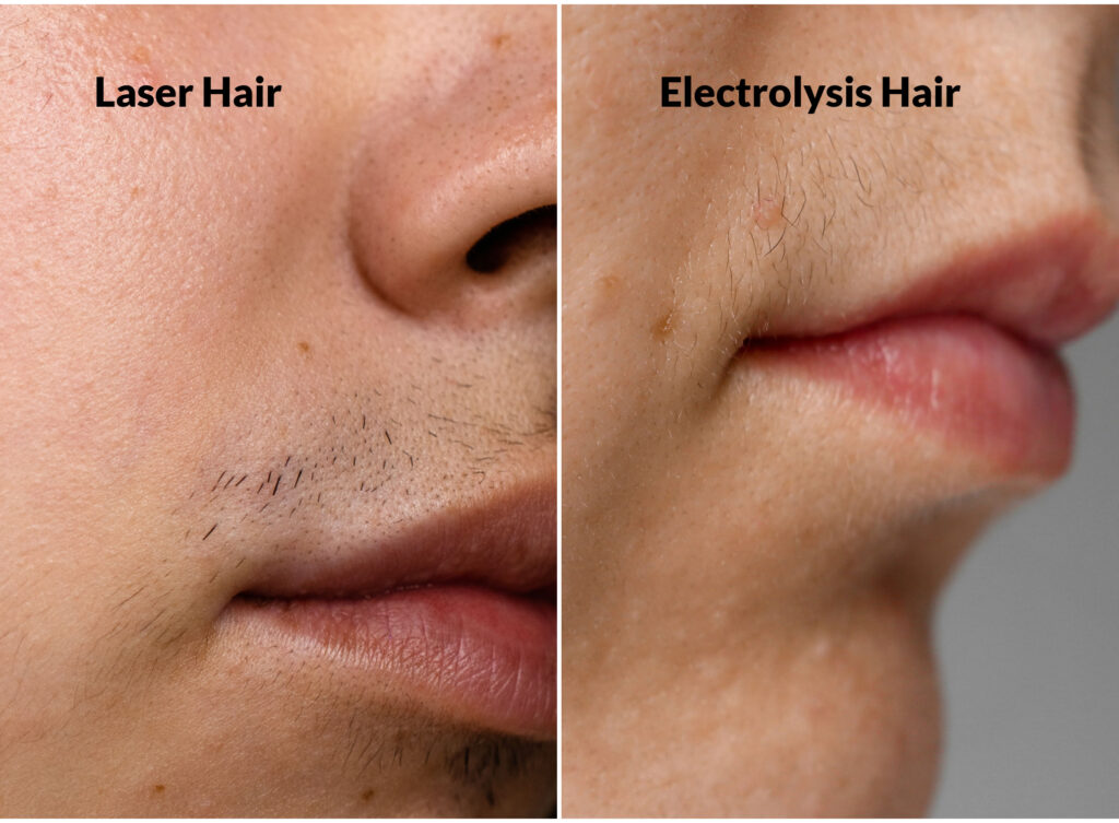A comparison of thick, coarse "laser hair" and thin/fine "electrolysis hair"