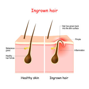 What causes an ingrown hair