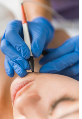 Electrologist performing electrolysis hair removal woman chin