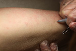 A technicians hands on a leg, applying the electrolysis procedure for hair removal. 