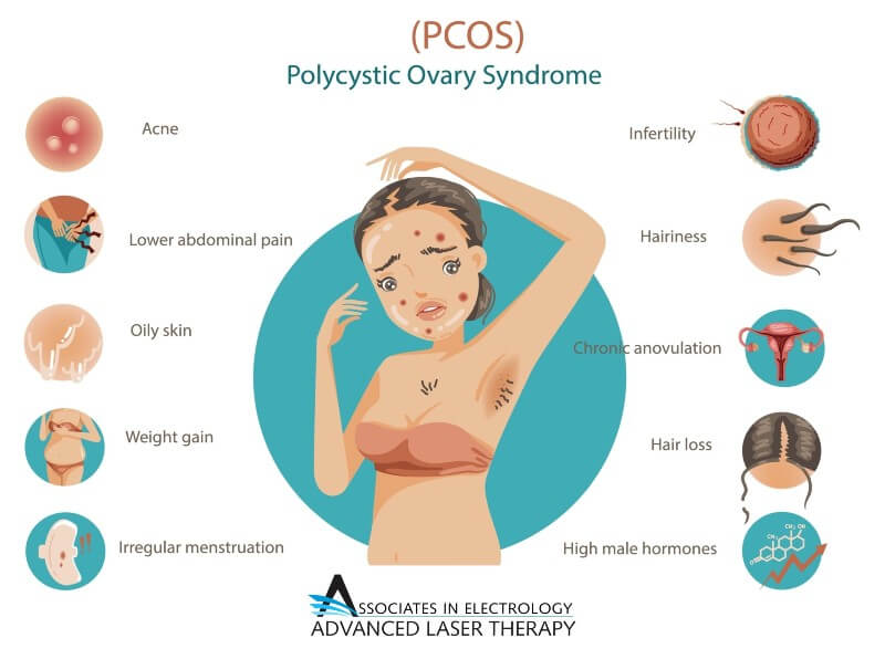 Poster showing all of the treatable conditions related to Polycystic Ovary Syndrome